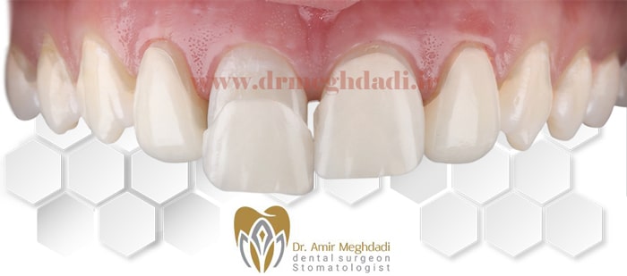 اصلاح-نواقص-دندان-