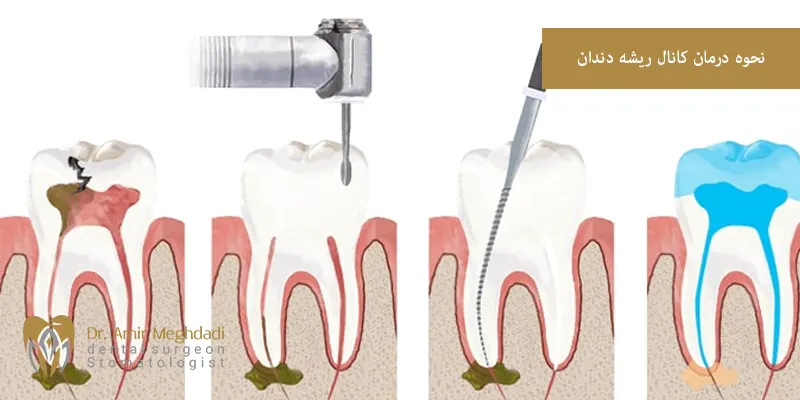 نحوه درمان کانال ریشه دندان