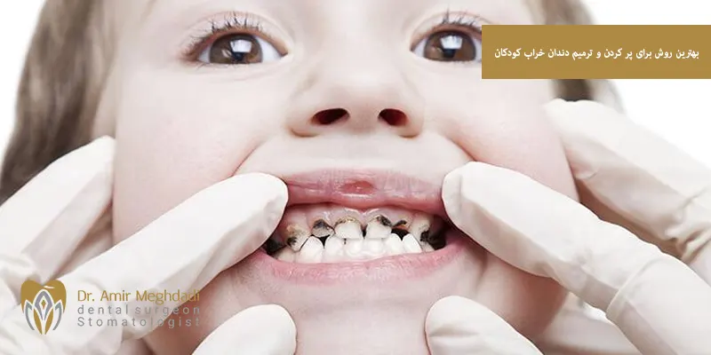 بهترین روش برای پر کردن و ترمیم دندان خراب کودکان