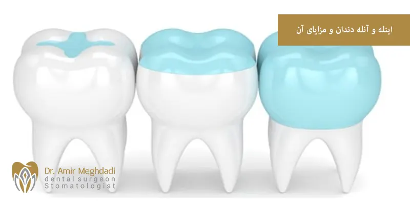 اینله و آنله دندان و مزایای آن