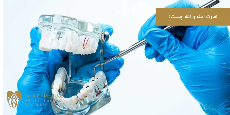 تفاوت اینله و آنله چیست؟