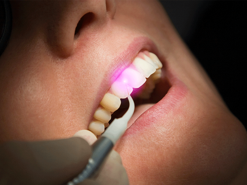 کاربرد-لیزر-در-دندانپزشکی-
