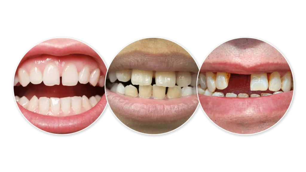 فاصله های بین دندانی
