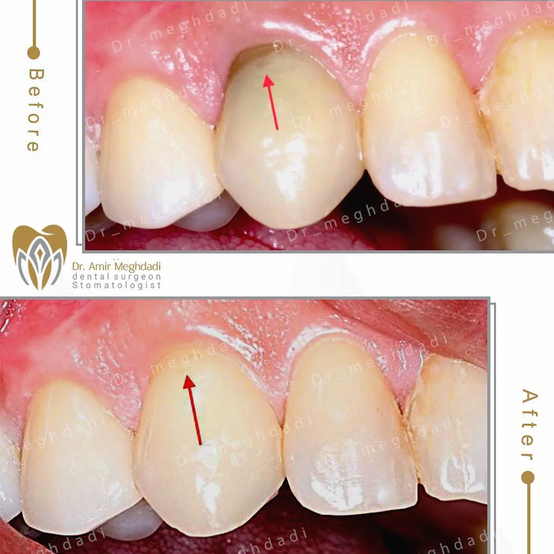ناحیه طوق دندان به علت درمان ریشه ( عصب کشی )تیره شده که با استفاده از سفید کردن داخلی دندان