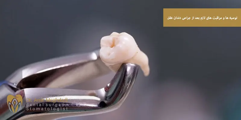 توصیه ها و مراقبت های لازم بعد از جراحی دندان عقل