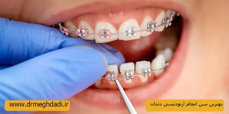 بهترین-سن-برای-انجام-ارتودنسی