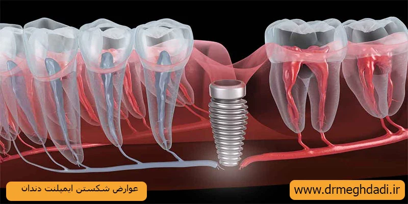 عوارض-شکستن-ایمپلنت-دندان
