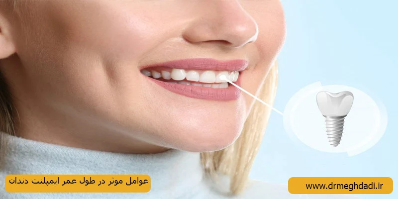 عومل-موثر-در--طول-عمر-ایمپلنت-دندان