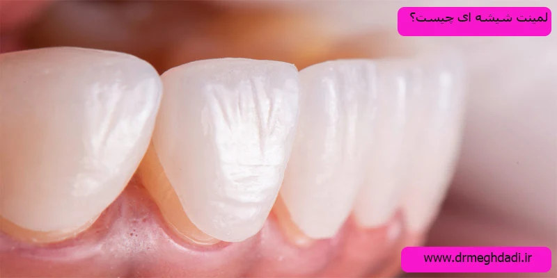 لمینت-شیشه-ای