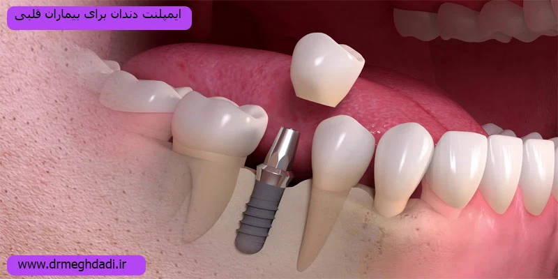 ایمپلنت-دندان-برای-بیماران-قلبی
