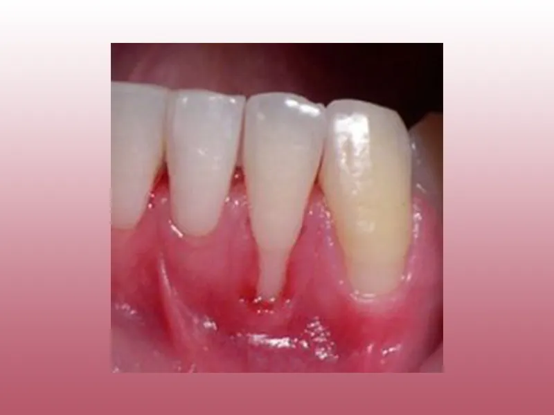 تحلیل لثه - دکتر امیر مقدادی