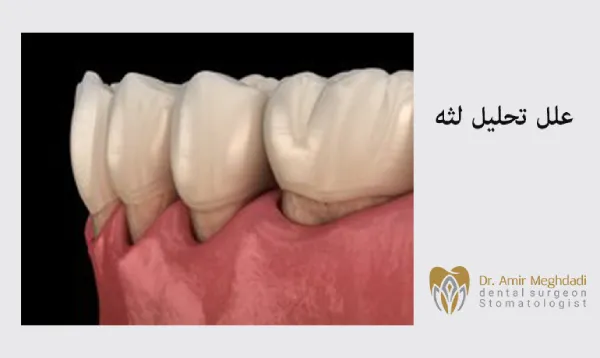  علل تحلیل لثه