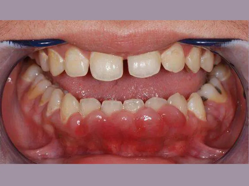 رشد بیش از حد لثه