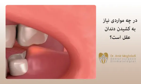 در چه مواردی نیاز به کشیدن دندان عقل است؟