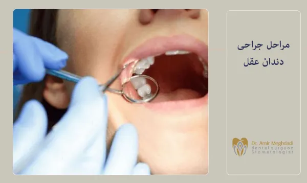 مراحل جراحی دندان عقل