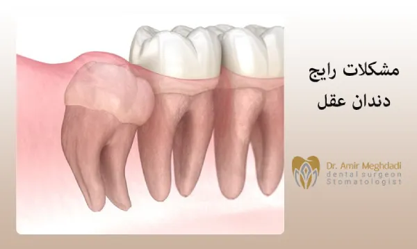 مشکلات رایج دندان عقل