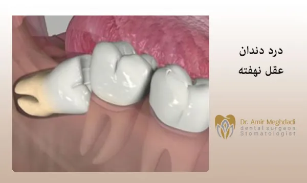 درد-دندان-عقل-نهفته