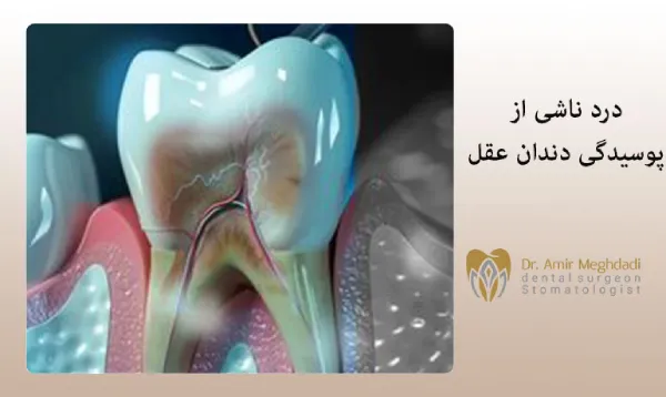 درد-ناشی-از-پوسیدگی-دندان-عقل