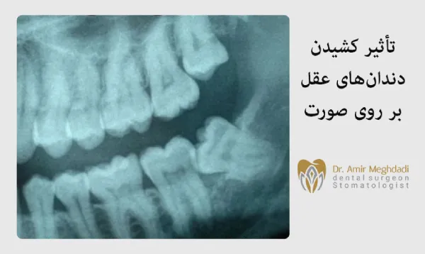 تأثیر-کشیدن-دندانهای-عقل-بر-روی-صورت