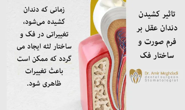 تاثیر-کشیدن-دندان-عقل-بر-فرم-صورت-و-ساختار-فک