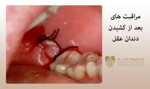 مراقبت های بعد از کشیدن دندان عقل