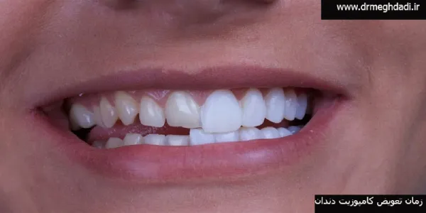 زمان-تعویض-کامپوزیت-دندان