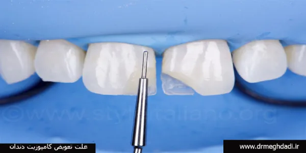 علت-تعویض-کامپوزیت-دندان