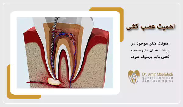 اهمیت عصب کشی