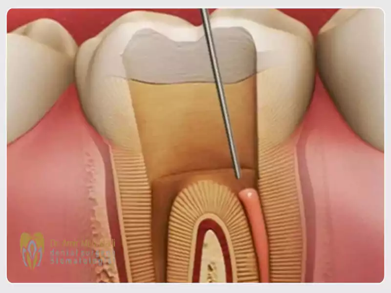 بهترین دکتر عصب کشی در پاسداران