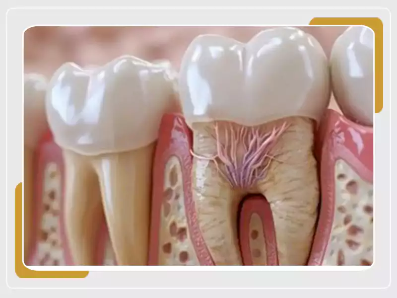 هزینه عصب کشی دندان