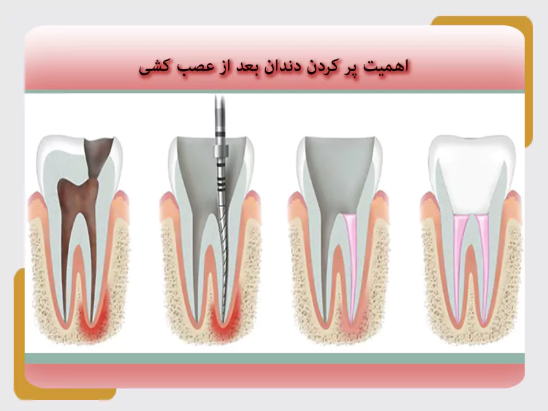 اهمیت پر کردن دندان بعد از عصب کشی