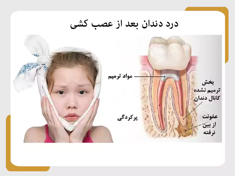 درد دندان بعد از عصب کشی