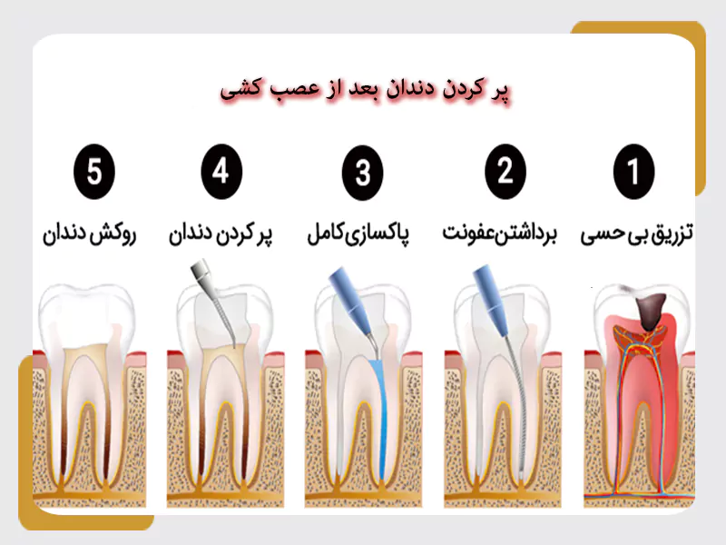 پر کردن دندان بعد از عصب کشی