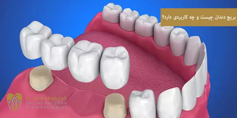 بریج دندان چیست و چه کاربردی دارد؟