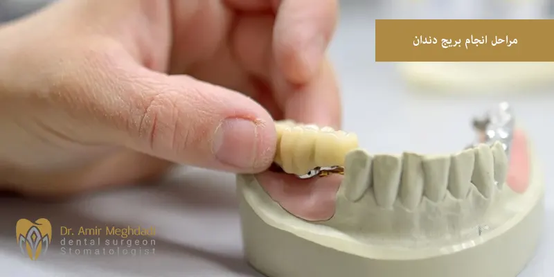 مراحل انجام بریج دندان
